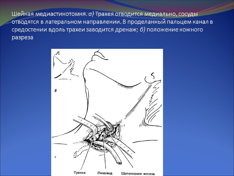 Шейная медиастинотомня. а) Трахея отводится медиально, сосуды отводятся в латеральном направлении. В проделанный пальцем